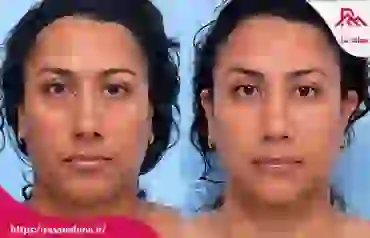 آشنایی با بهترین فیلر های زیر چشم