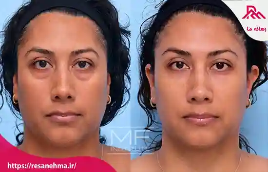 آشنایی با بهترین فیلر های زیر چشم