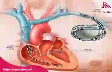 دانستنی های در خصوص گذاشتن باطری قلب