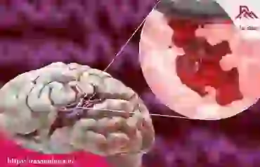 حقایقی در مورد سکته مغزی