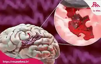 حقایقی در مورد سکته مغزی