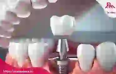 راهکارهای طلایی برای افزایش طول عمر ایمپلنت دندان