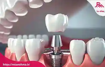 راهکارهای طلایی برای افزایش طول عمر ایمپلنت دندان