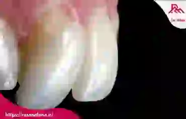 صفر تا صد تفاوت کامپوزیت ونیر و کامپوزیت سرامیکی