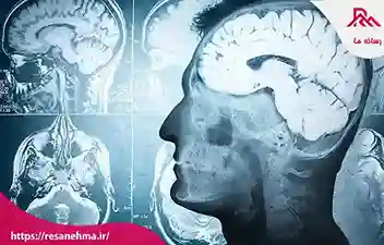آشنایی با انواع تومور خوش خیم و بد خیم مغزی