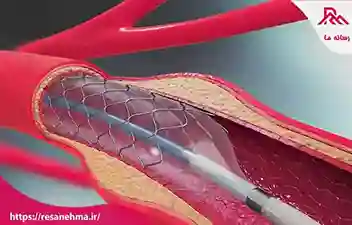 چه زمانی عمل آنژیوپلاستی انجام میشود؟