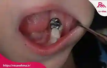 ناگفته های از گذاشتن روکش دندان کودکان